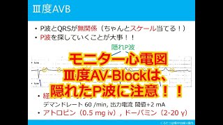 【モニター心電図】極論と独断で語るモニター心電図　第５話　Ⅲ度AV-Blockは、隠れたP波に注意！！