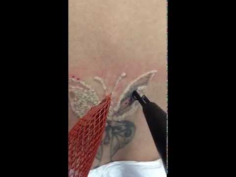 Laser Tattoo Removal