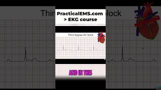 Third Degree AV Block: Complete Heart Disconnect Explained