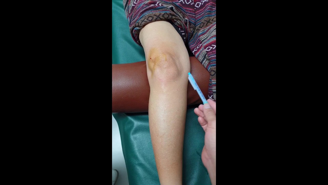 ข้อเข่าเสื่อม สาเหตุของการปวดเข่า OA KNEE, Osteoarthritis of knee