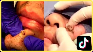 Pimple Popping Videos Compilations Tik Tok  #내성발톱 #ASMR #blackheads  #blackhead #pimple #acne