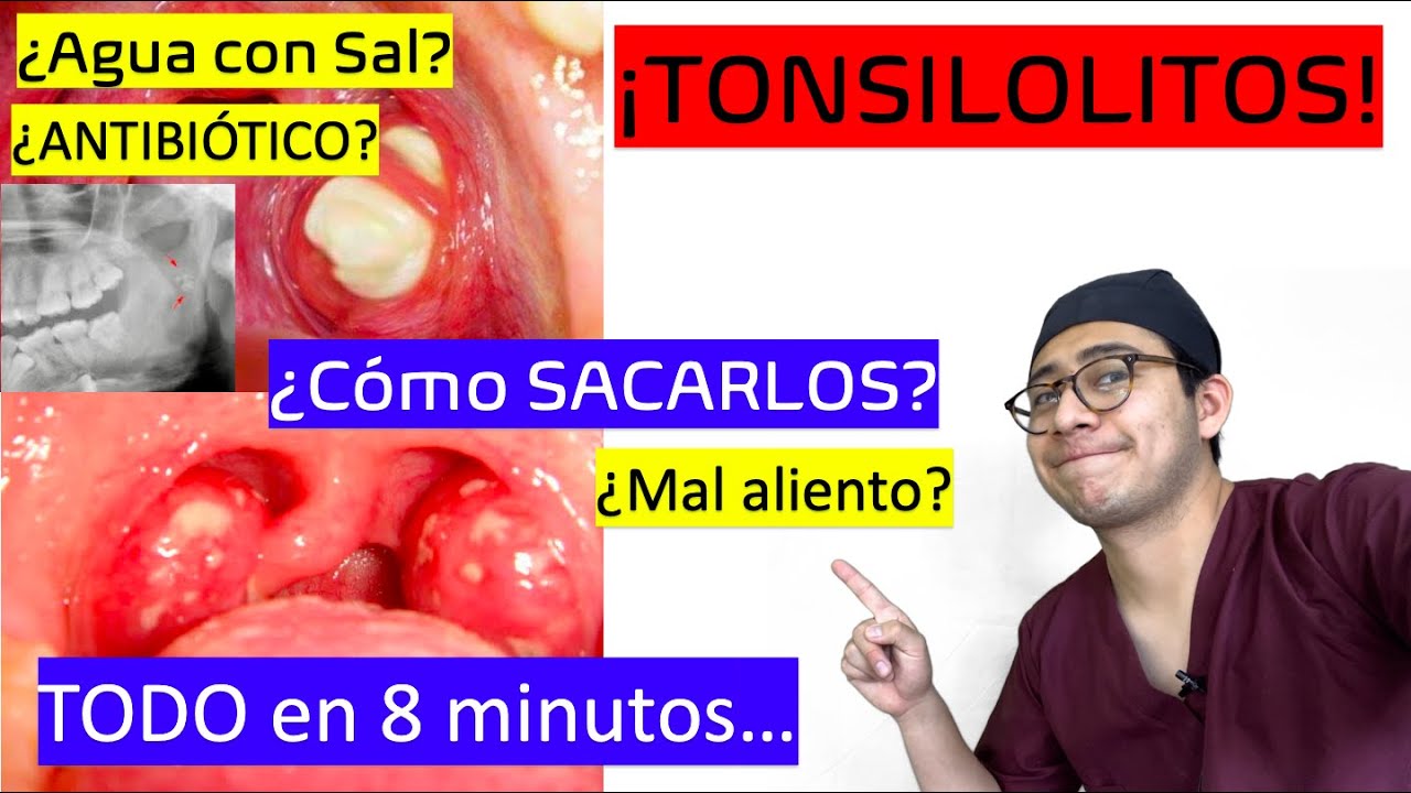 Tonsilolitos Bolitas Blancas Mal Aliento En 8 Minutos Youtube