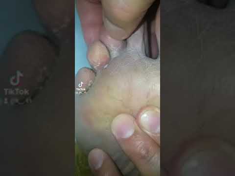 الفطريات بين اصابع القدم