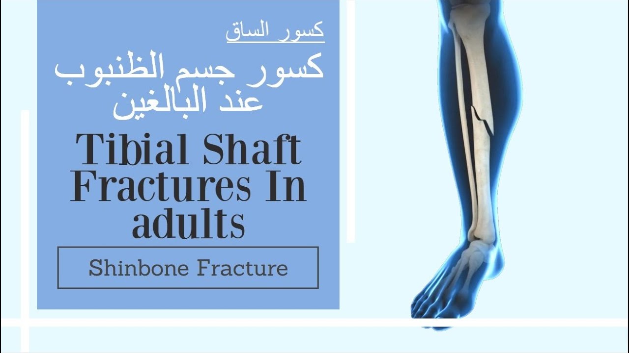 كسور الساق عند البالغين - كسر قصبة الساق - كسر الظنبوب Tibial Shaft Fractures In adults (subtitled)