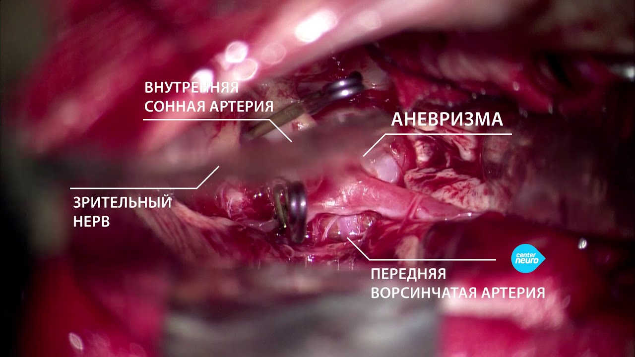 ⁣Гигантская аневризма головного мозга: операция, интервью с нейрохирургом Царикаевым А.В.