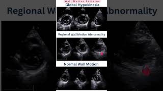 SAX View Interpretation – Wall Motion Patterns #WallMotion #GlobalHypokinesia #RWMA #LVFunction