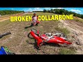 Broken Collarbone at Backyard MX Track