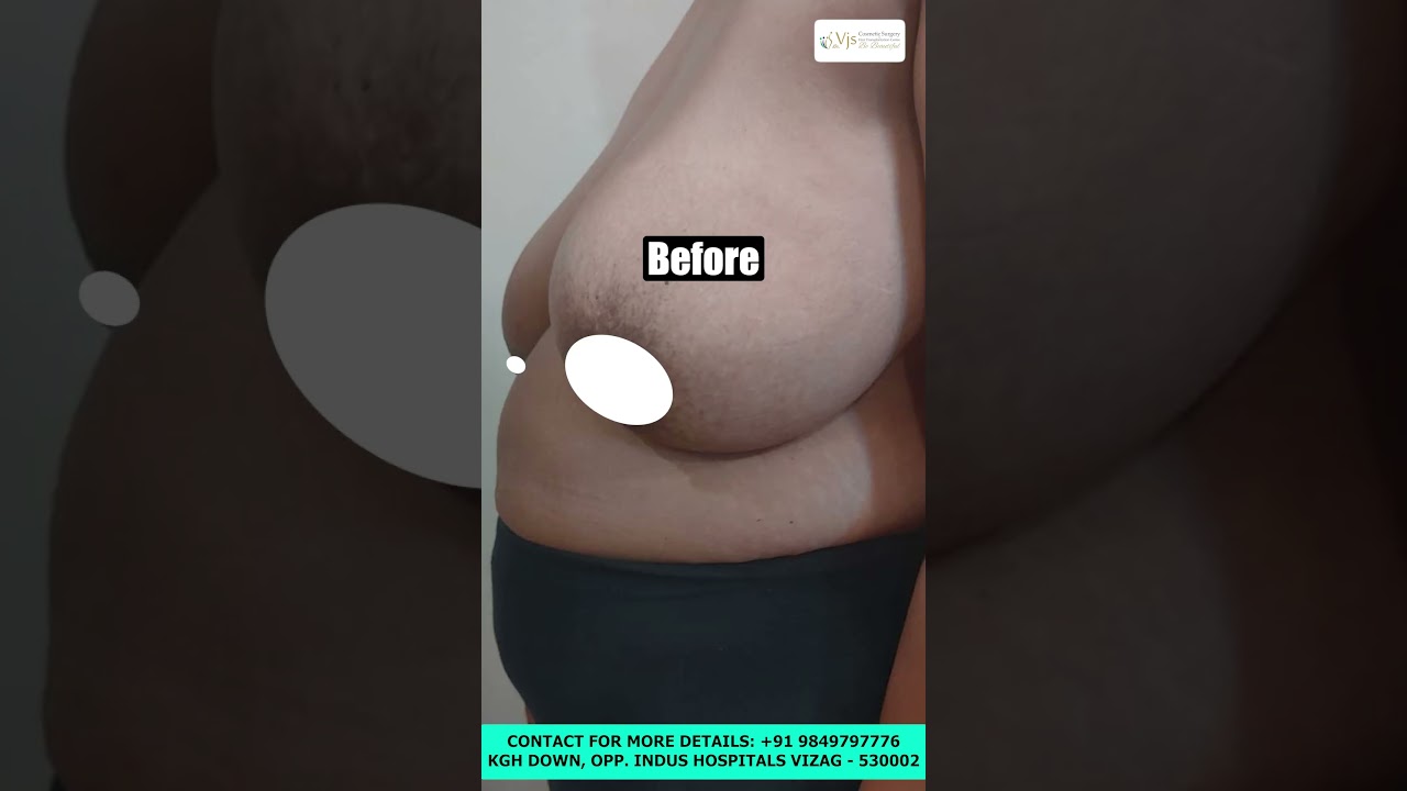 Breast Reduction Surgery at VJS Clinic | Real Relief, Real Confidence