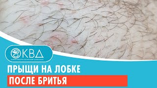 🙁 Прыщи на лобке после бритья. Клинический случай №930