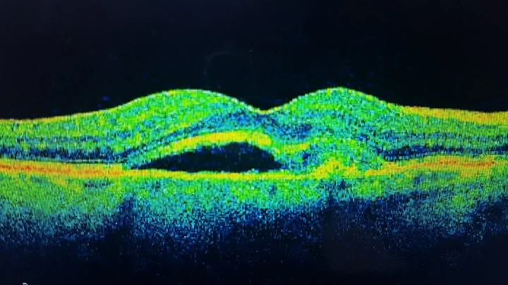 Macular Degeneration: Causes, Symptoms, Treatments