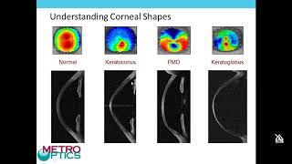 KeraSoft IC Soft Lens for Irregular Cornea Webinar screenshot 2