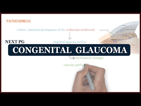 Congenital Glaucoma | ophthalmology | NEXT PG
