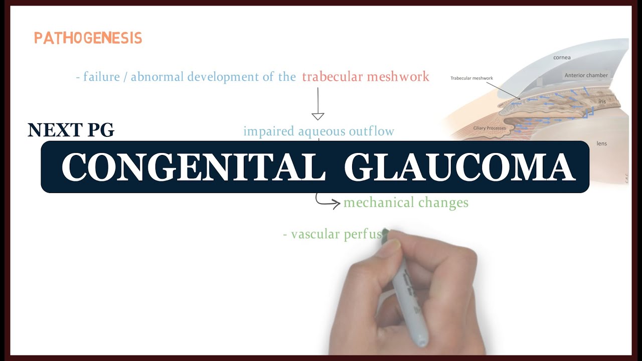 Congenital Glaucoma | Ophthalmology | Next Pg