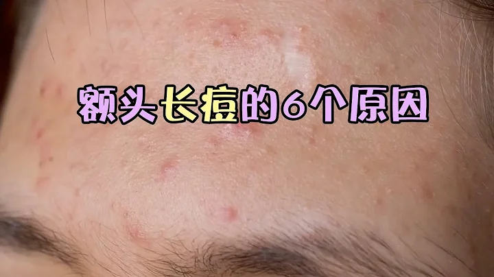 饮食不规律？额头长痘的这6个原因你中了其中哪一个？ - 天天要闻