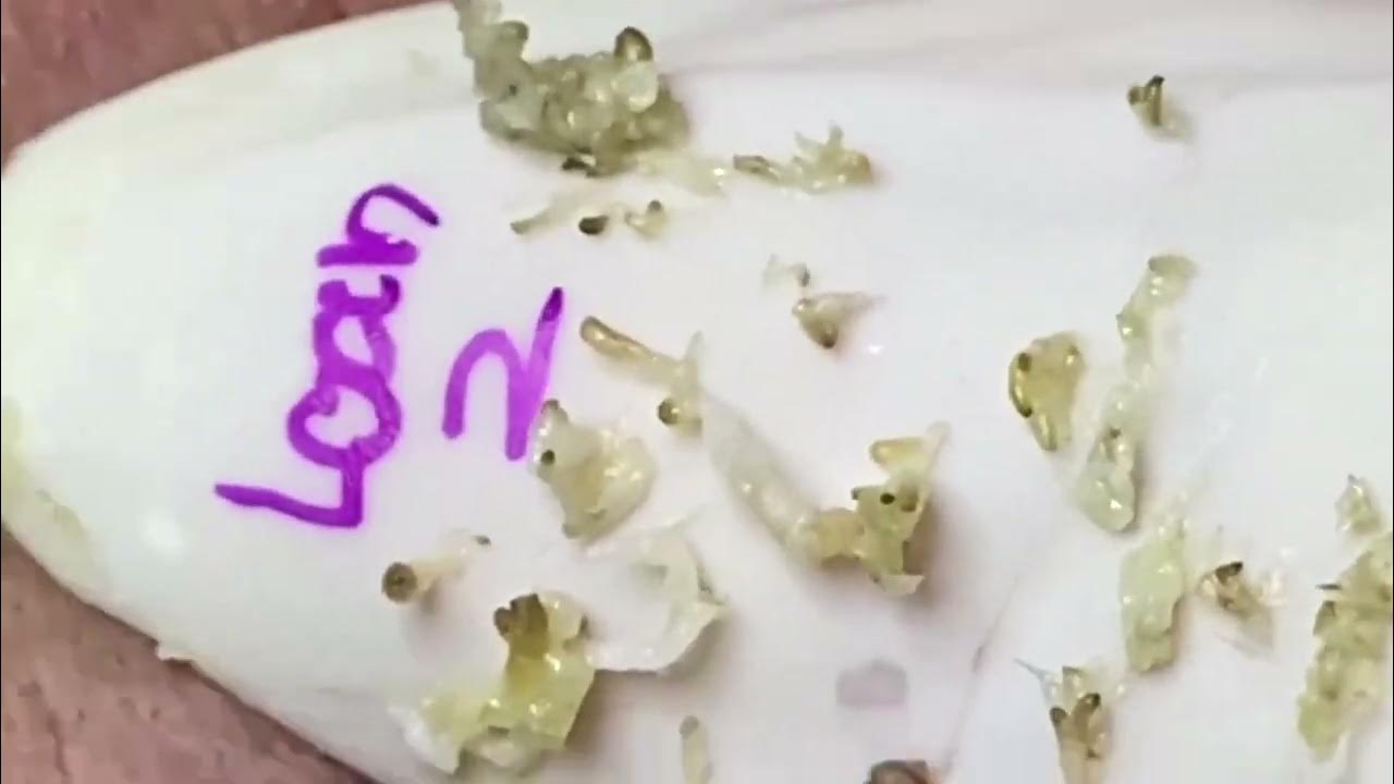 Extreme blackhead Removal at SRN Skin Care enilsa brown 1003 YouTube