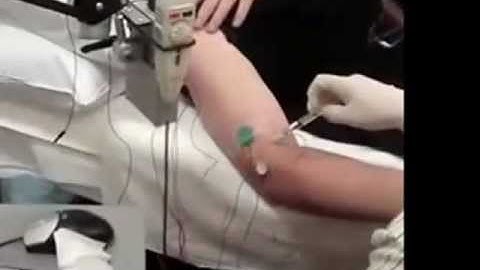 Botox injections in arm for MS (Multiple Sclerosis)