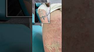 Tattoo Removal With Picoselaser