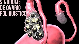 Sindrome de Ovario Poliquistico - ¿Que es? - Diagnostico - Complicaciones - Tratamientos