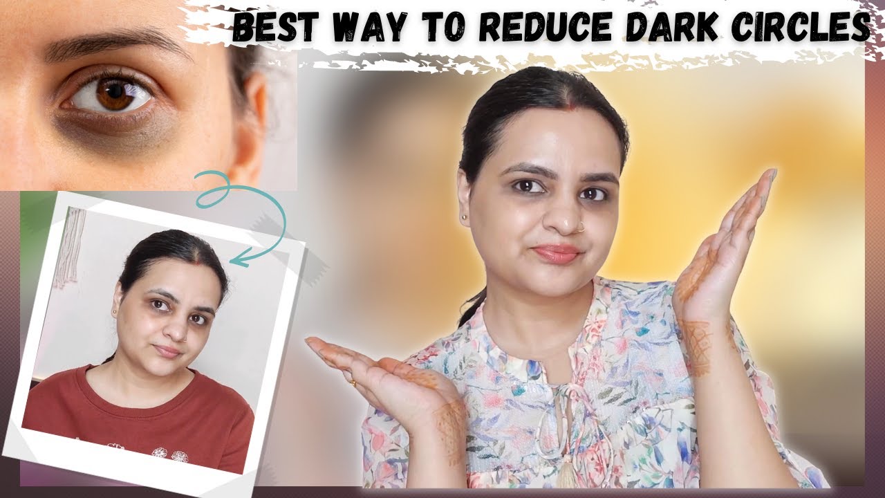 How to Get rid of Dark Circles & Under eye bags Permanently