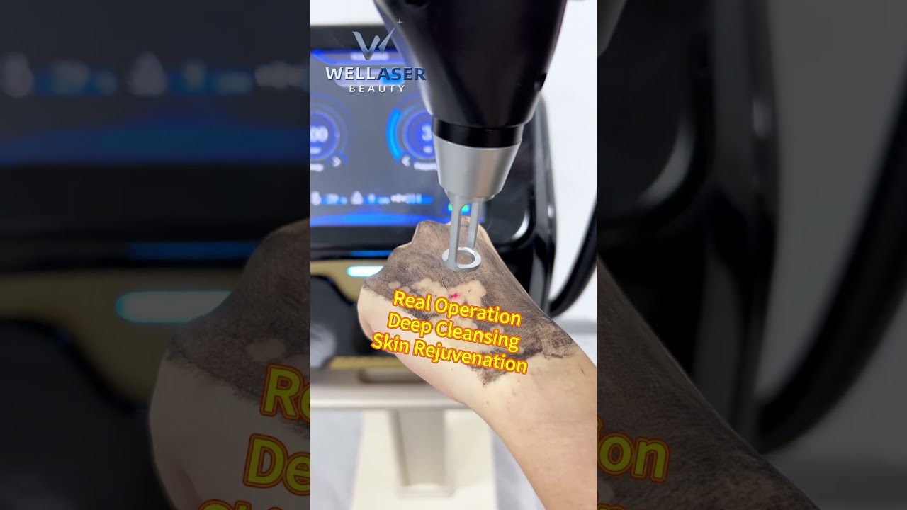 Wellaser Beauty PicoLaser Carbon Peel Black Doll | Professional Manufacturer China