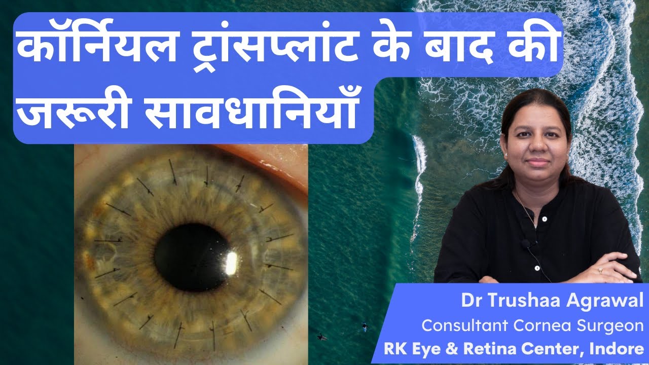 Corneal transplant के बाद क्या सावधानियाँ रखें ? Precautions after KERATOPLASTY.