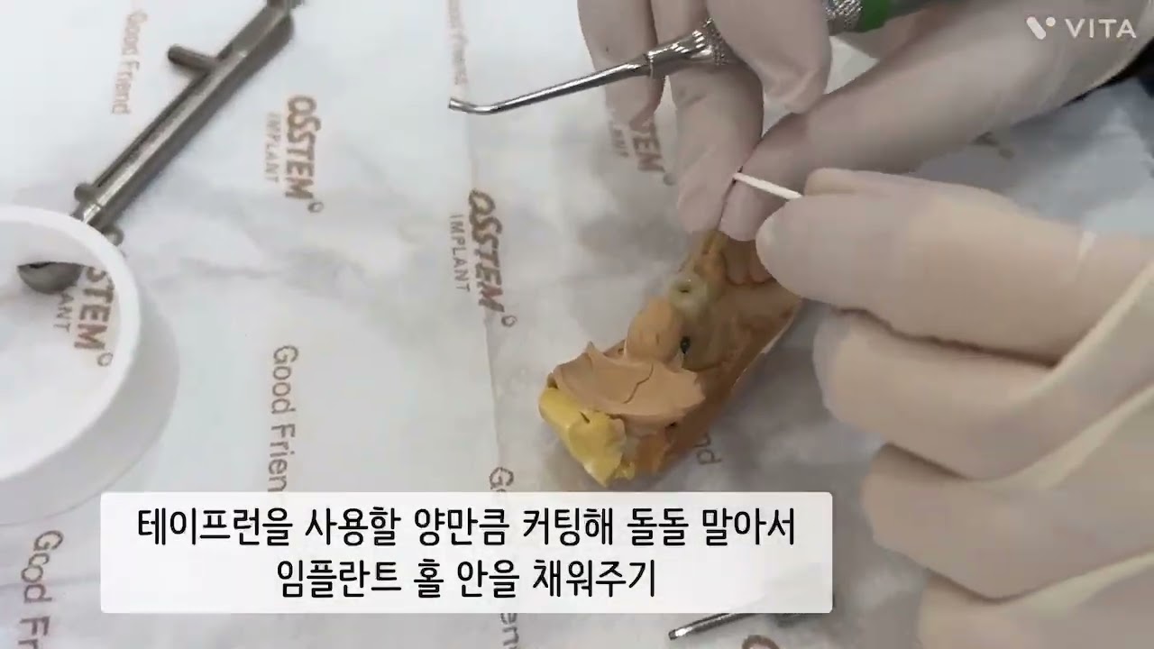 임플란트 토크/ 홀 매꾸기