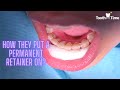 how do they put a permanent retainer on? Braces at Tooth Time Family Dentistry New Braunfels