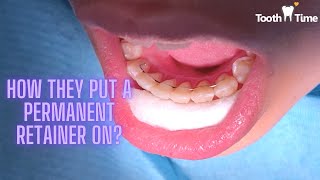 how do they put a permanent retainer on? Braces at Tooth Time Family Dentistry New Braunfels