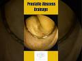 Doctors Drain a Prostate Abscess and THIS Happens!