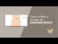 Endometriose - Como é feita a cirurgia?