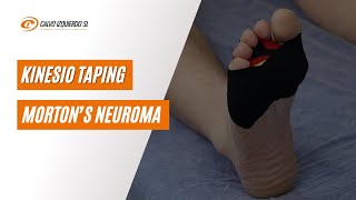 Kinesio Taping for Morton’s Neuroma and Metatarsalgia