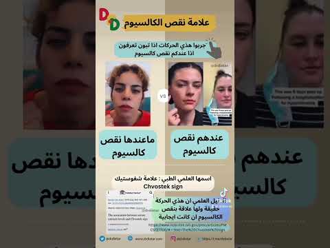 علامة شيفوستيك تدل على نقص الكالسيوم