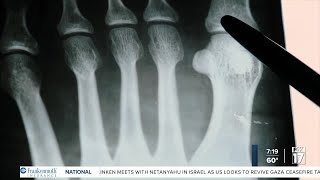 No bones about it - Celebrate (and support) your bones on World Osteoporosis Day