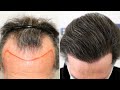 FUE Hair Transplant (4225 Grafts NW III Vertex) By Dr Juan Couto - FUEXPERT CLINIC, Madrid, Spain