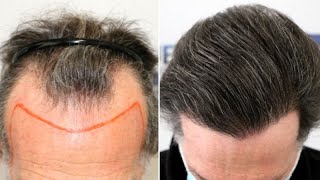 FUE Hair Transplant (4225 Grafts NW III Vertex) By Dr Juan Couto - FUEXPERT CLINIC, Madrid, Spain