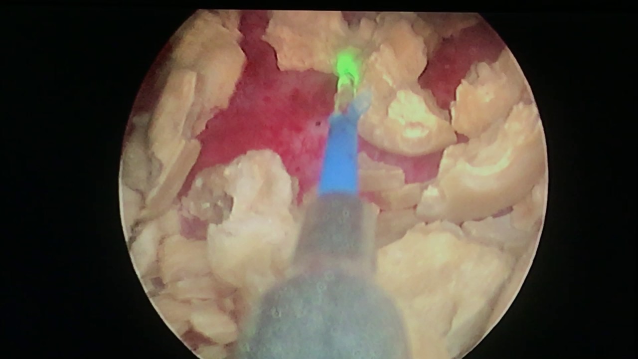 bladder stone lithotripsy bladder stone lithotripsy