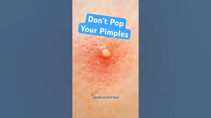 Why Popping Pimples Makes Them Worse