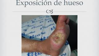 capilares rotos en los pies