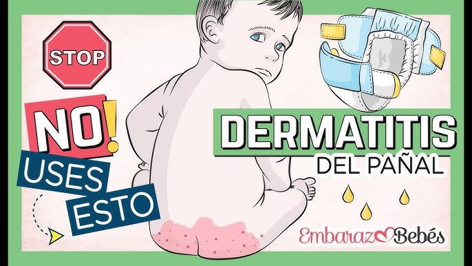 Dermatitis del pañal: qué es y con qué tipo de cremas tratarla