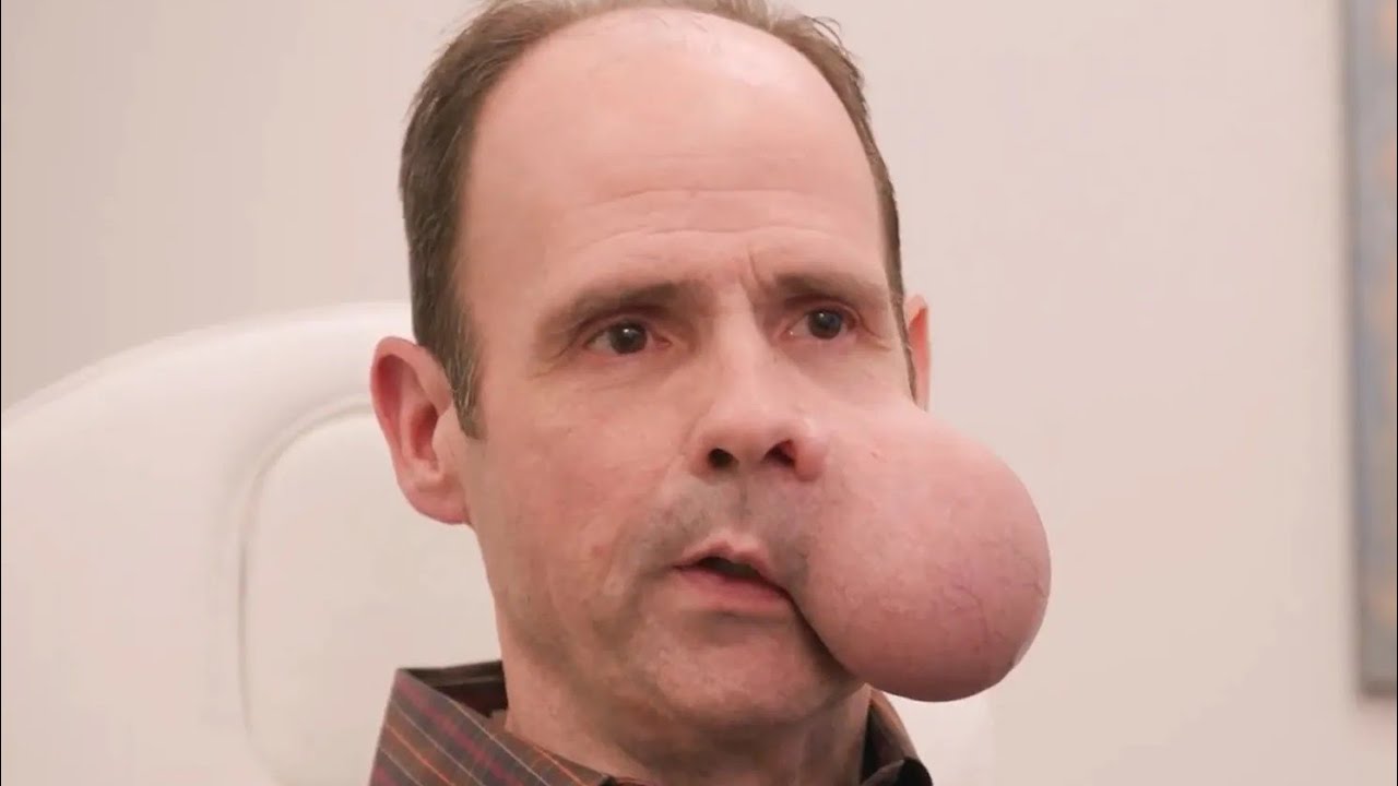 Мужчине с опухолью весом 1,8 кг предстоит операция, которая изменит его жизнь | О нас: Face TLC