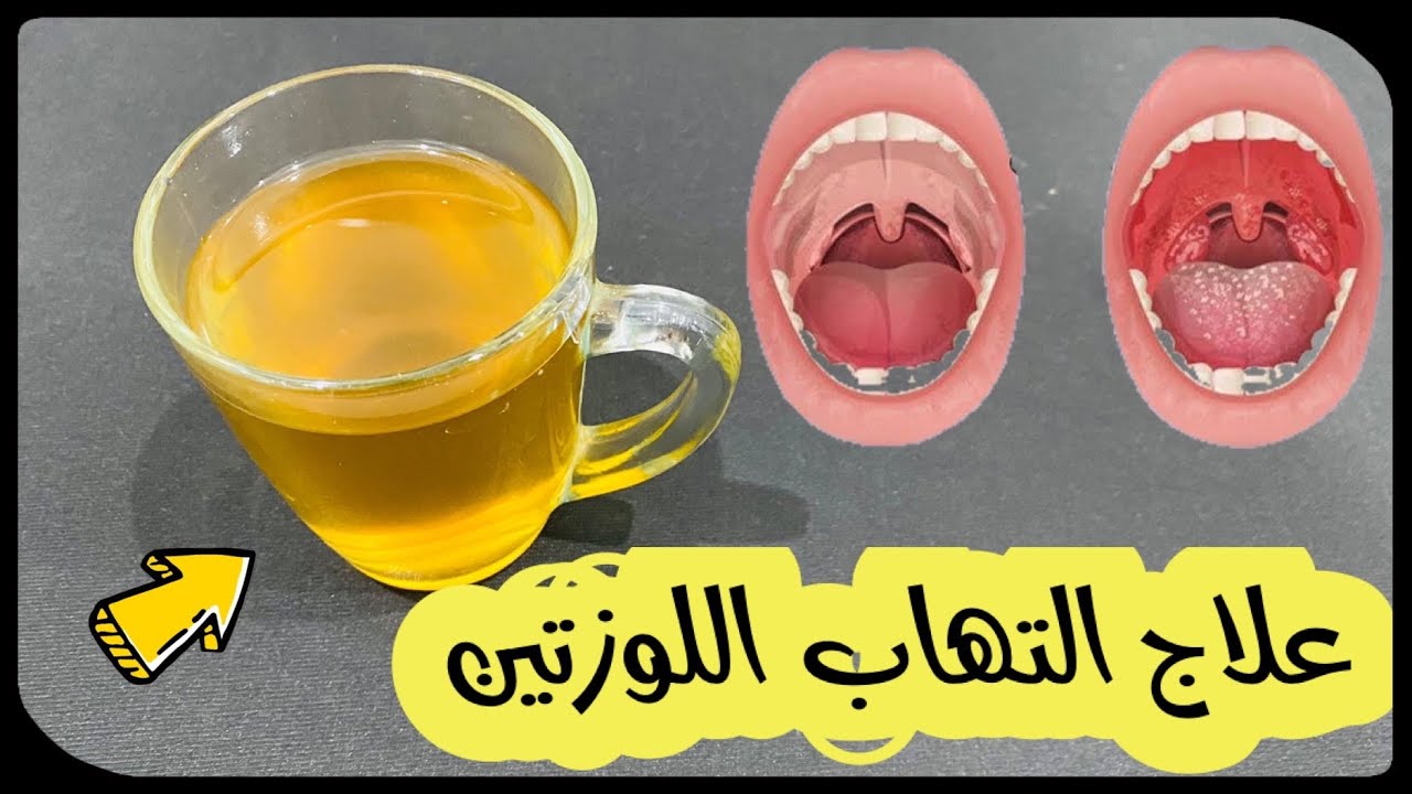 الحلق الملتهب علاج كيف أعالج