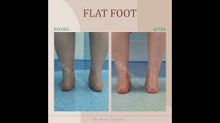 Flat Foot
