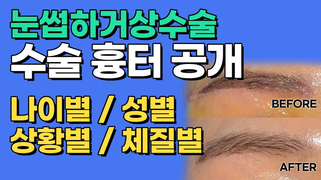눈썹하거상수술 나이별/성별/상황별/체질별 수술흉터 공개합니다