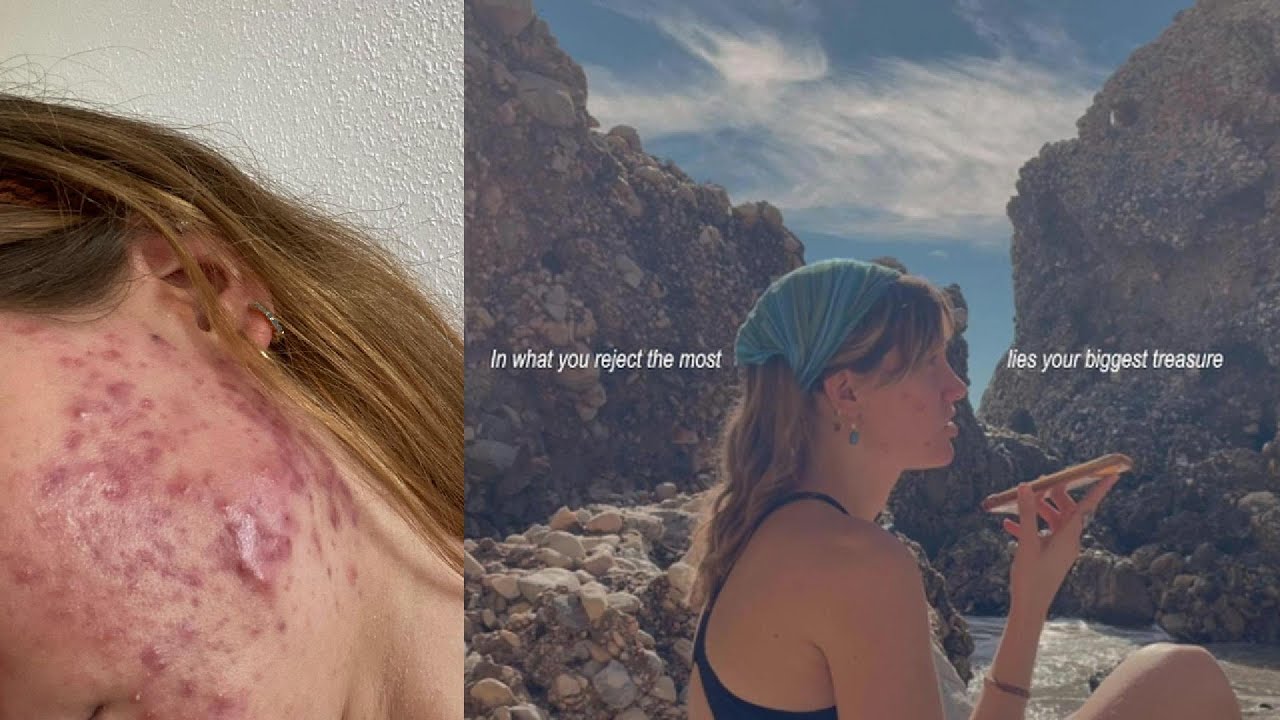 Why Acne Is Your Biggest Gift