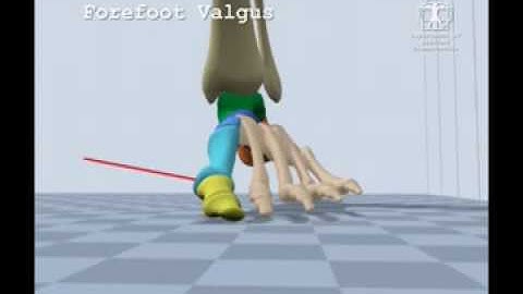 Forefoot Valgus Gait