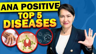 Top 5 Diseases with A Positive ANA (Antinuclear Antibodies) Test