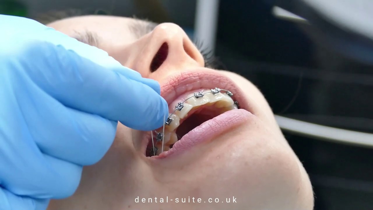 Why are elastics/rubber bands used in brace treatment? Orthodontics