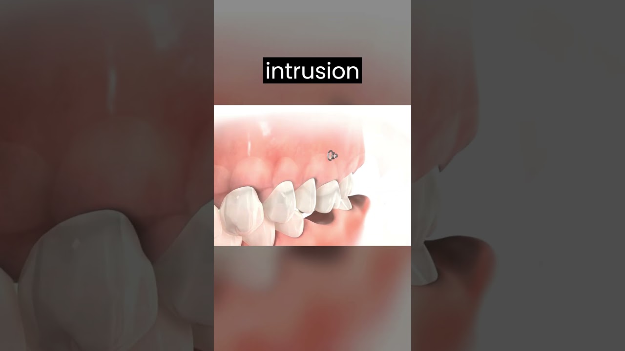 TADs 2 : The next level Orthodontic treatment technique