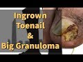 Ingrown Toenail and Big Granuloma Removal