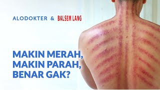 Kerokan Makin Merah, Masuk Angin Makin Parah, Begini Faktanya